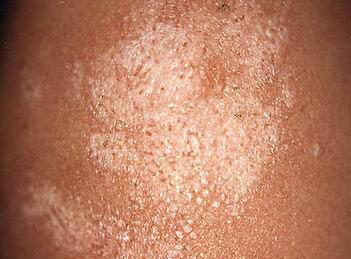 苔癣是什么皮肤病