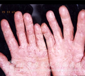 手癣和手部湿疹怎么区别