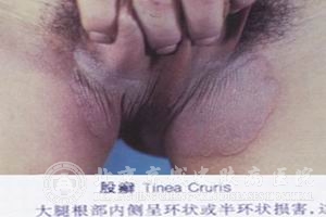 Ѣ(Tinea cruris)ԤʩЩ