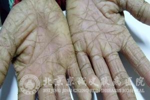 皲裂症的治疗措施_手足皲裂_北京京城皮肤病医院(北京