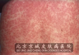 北京京城皮肤医院 皮炎 过敏性药物皮炎容易与什么病相混淆
