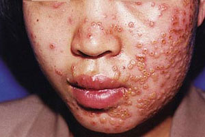 单纯疱疹是如何发病的_北京京城皮肤医院(北京医保)