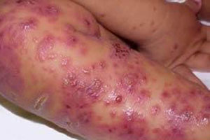 传染性湿疹样皮炎的症状表现有哪些