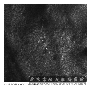 来我院就诊过的一部分女性患者一直以为自己脸上长的是   颧部褐青色