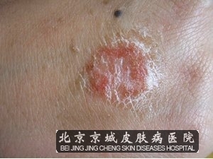 大腿内侧痒是怎么回事_其他皮肤病_北京京城皮肤病