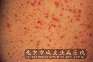 北京京城介绍过敏性皮炎的偏方有哪些