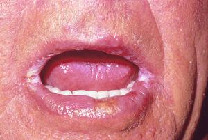 口角炎是由于真菌性的感染导致的,出现了口角炎会使我们的日常生活