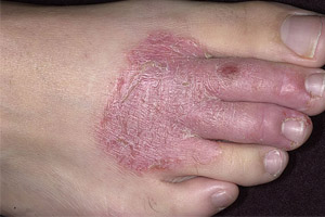 那么脚湿疹该怎么治呢?脚湿疹最佳治疗方法?   脚湿疹最佳治疗方法?