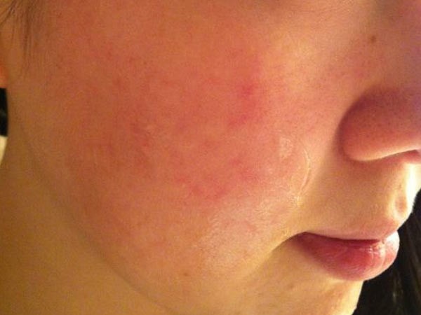女性脸部出现过敏的症状 - 皮肤病 - 39健康网