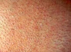症状诊断:毛发红糠疹是一种慢性炎症性皮肤病,其特征为小的毛囊角化性