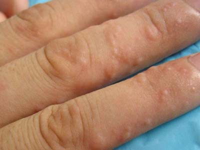 汗疱疹是什么原因导致