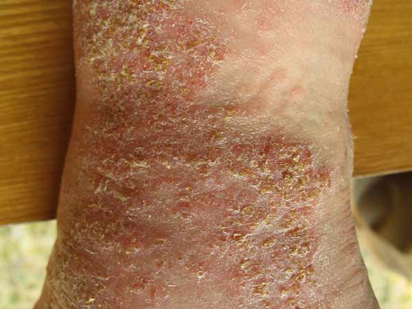 慢性湿疹的症状特点是哪些