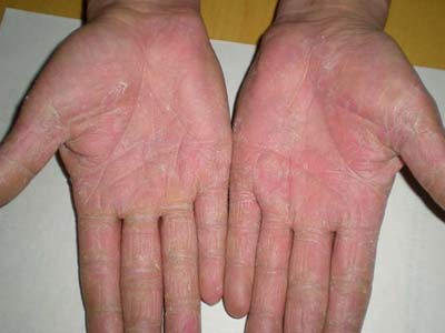 手癣的发病原因具体是哪些