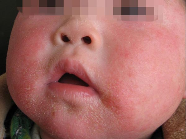 得了婴儿湿疹的危害有什么